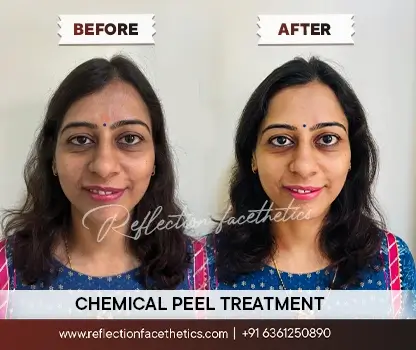 Chemical Peel Treatment in Bangalore Before after